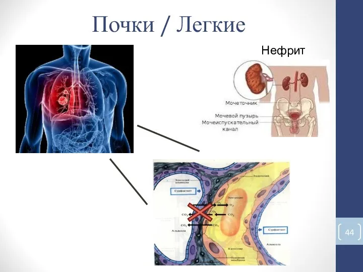 Почки / Легкие Нефрит