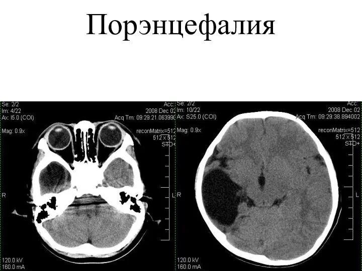 Порэнцефалия