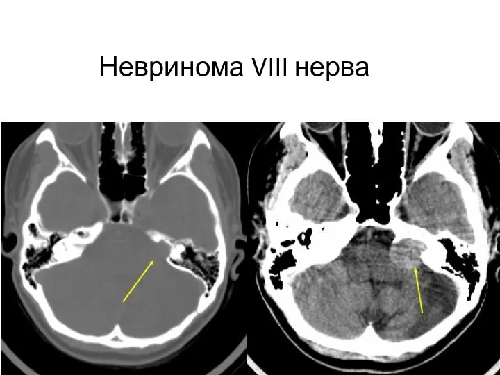 Невринома VIII нерва