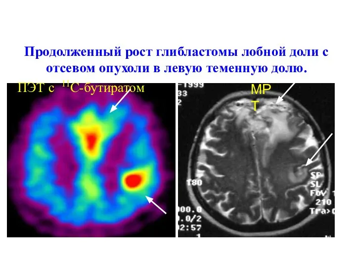 Продолженный рост глибластомы лобной доли с отсевом опухоли в левую теменную долю. ПЭТ с 11С-бутиратом МРТ