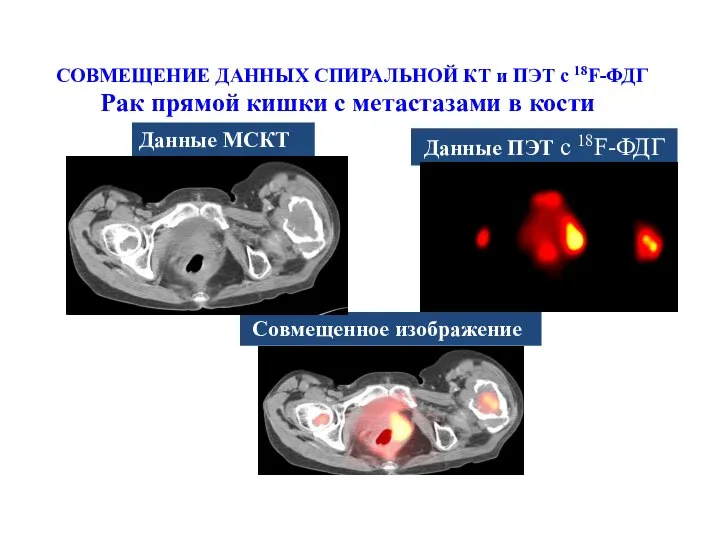 СОВМЕЩЕНИЕ ДАННЫХ СПИРАЛЬНОЙ КТ и ПЭТ с 18F-ФДГ Данные ПЭТ с 18F-ФДГ