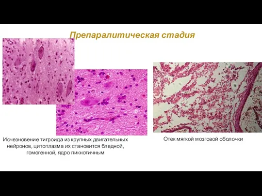 Препаралитическая стадия Отек мягкой мозговой оболочки Исчезновение тигроида из крупных двигательных нейронов,