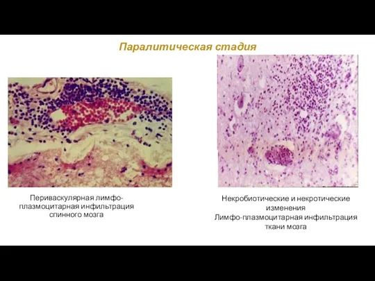 Паралитическая стадия Периваскулярная лимфо-плазмоцитарная инфильтрация спинного мозга Некробиотические и некротические изменения Лимфо-плазмоцитарная инфильтрация ткани мозга