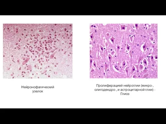 Пролиферацией нейроглии (микро-, олигодендро-, и астроцитарной глии) - Глиоз Нейронофагический узелок