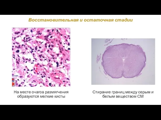 Восстановительная и остаточная стадии Стирание границ между серым и белым веществом СМ