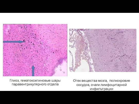 Глиоз, гематоксилиновые шары паравентрикулярного отдела Отек вещества мозга, полнокровие сосудов, очаги лимфоцитарной инфильтрации