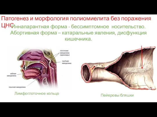 Патогенез и морфология полиомиелита без поражения ЦНС Иннапарантная форма - бессимптомное носительство.