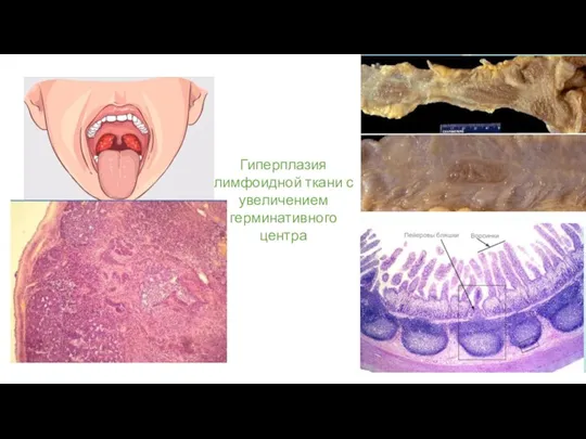 Гиперплазия лимфоидной ткани с увеличением герминативного центра