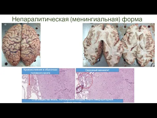 Отек вещества мозга, полнокровие сосудов, очаги лимфоцитарной инфильтрации Серозный менингит Кровоизлияния в