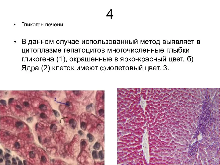 4 Гликоген печени В данном случае использованный метод выявляет в цитоплазме гепатоцитов