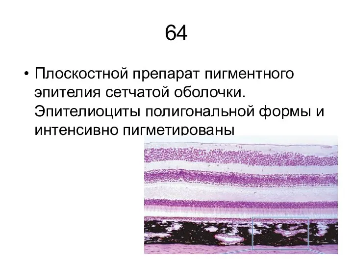 64 Плоскостной препарат пигментного эпите­лия сетчатой оболочки. Эпителиоциты полигональной формы и интенсивно пигметированы