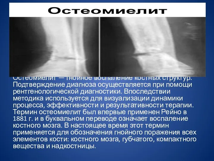 Остеомиелит — гнойное воспаление костных структур. Подтверждение диагноза осуществляется при помощи рентгенологической