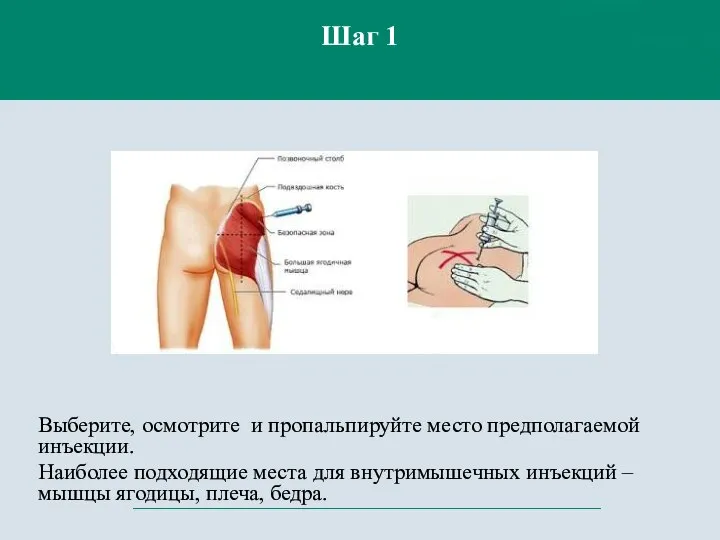 Выберите, осмотрите и пропальпируйте место предполагаемой инъекции. Наиболее подходящие места для внутримышечных