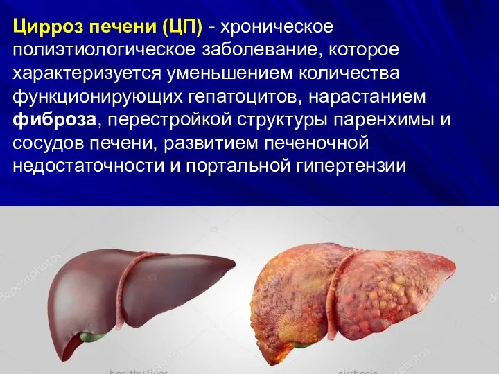 Цирроз печени (ЦП) - хроническое полиэтиологическое заболевание, которое характеризуется уменьшением количества функционирующих