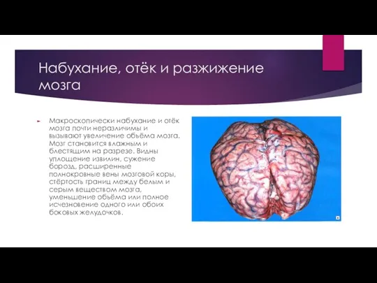 Набухание, отёк и разжижение мозга Макроскопически набухание и отёк мозга почти неразличимы