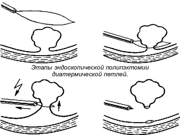 Этапы эндоскопической полипэктомии диатермической петлей.