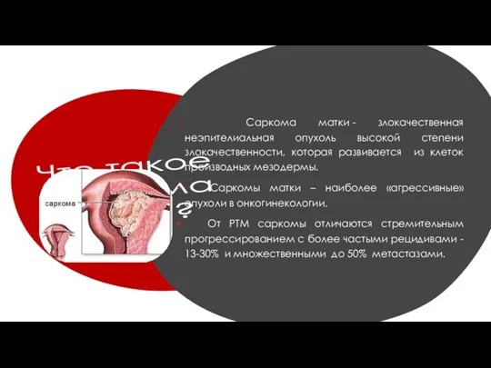 Что такое саркома матки? Саркома матки - злокачественная неэпителиальная опухоль высокой степени