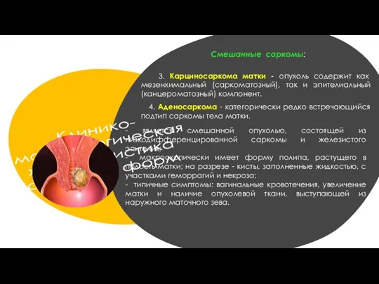 Клинико- морфологическая характеристика отдельных форм 3. Карциносаркома матки - опухоль содержит как