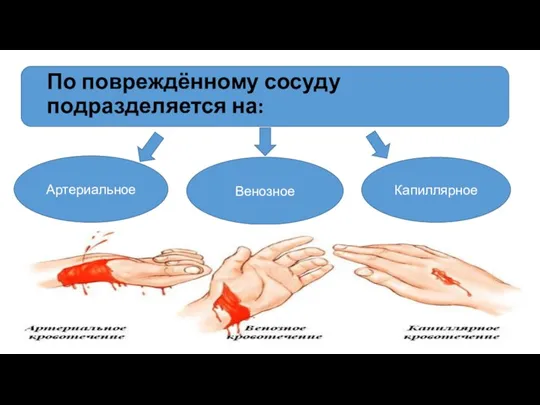 Артериальное Венозное Капиллярное По повреждённому сосуду подразделяется на: