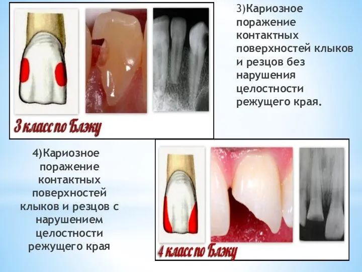 3)Кариозное поражение контактных поверхностей клыков и резцов без нарушения целостности режущего края.