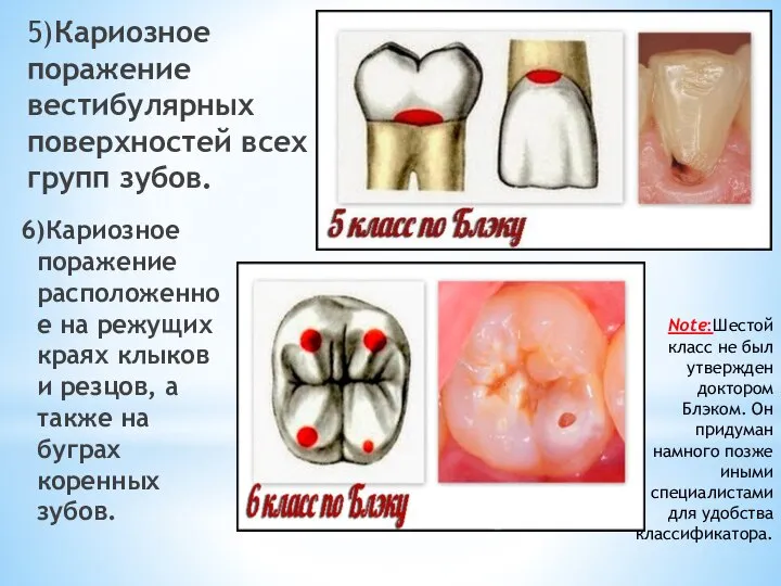 5)Кариозное поражение вестибулярных поверхностей всех групп зубов. 6)Кариозное поражение расположенное на режущих