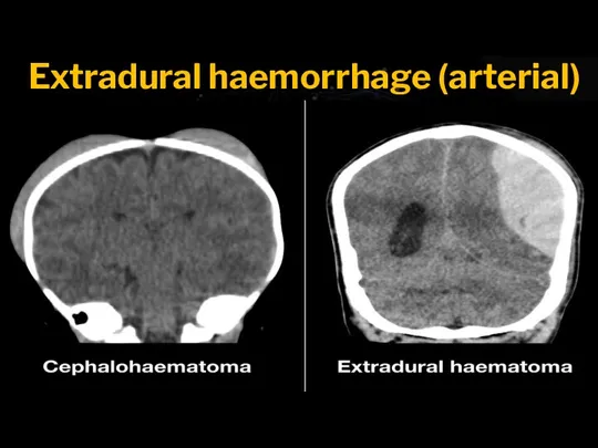 Extradural haemorrhage (arterial)