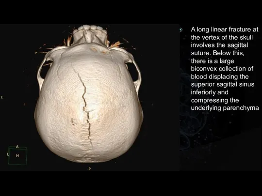 A long linear fracture at the vertex of the skull involves the