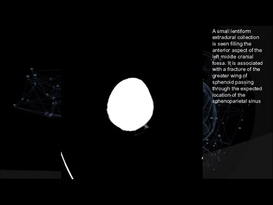 A small lentiform extradural collection is seen filling the anterior aspect of