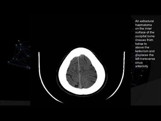 An extradural haematoma on the inner surface of the occipital bone crosses