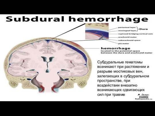 Субдуральные гематомы возникают при растяжении и разрыве мостиковых вен, залегающих в субдуральном