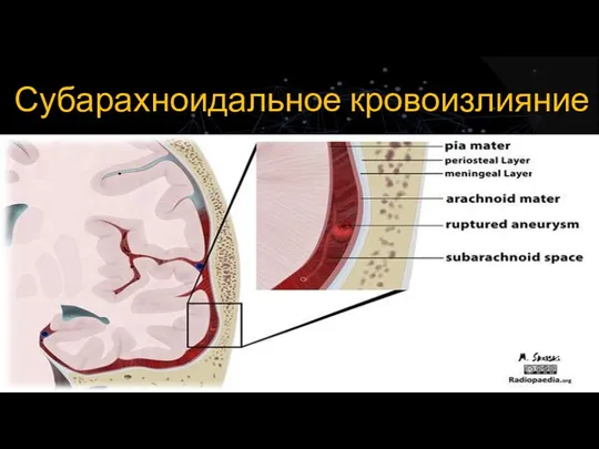 Субарахноидальное кровоизлияние