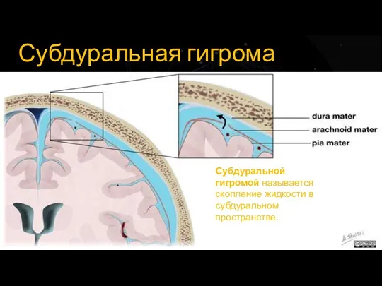 Субдуральная гигрома Субдуральной гигромой называется скопление жидкости в субдуральном пространстве.