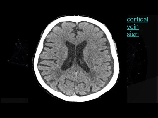 cortical vein sign