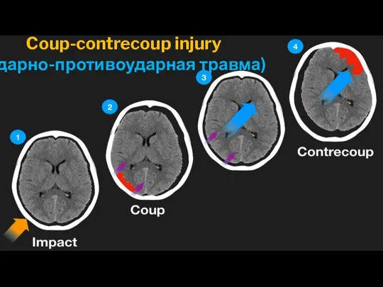 Coup-contrecoup injury (Ударно-противоударная травма)