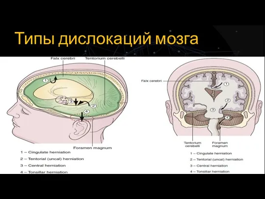 Типы дислокаций мозга