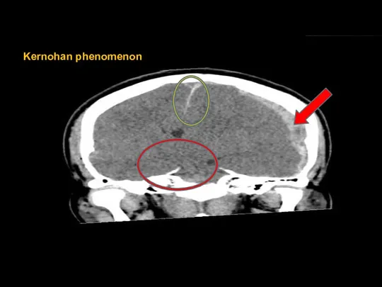 Kernohan phenomenon