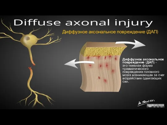 Диффузное аксональное повреждение (ДАП) Диффузное аксональное повреждение (ДАП) - это тяжелая форма
