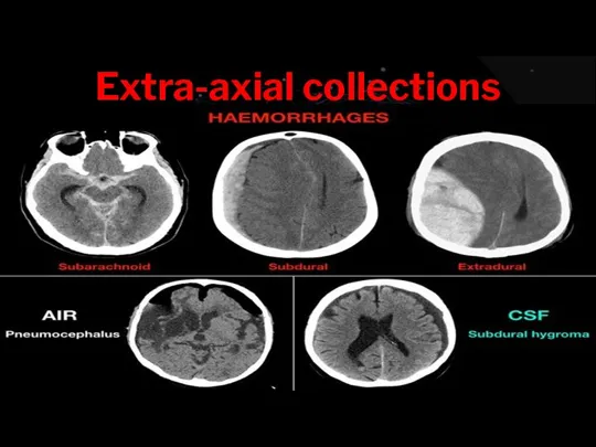 Extra-axial collections