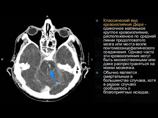 Классический вид кровоизлияния Дюре - одиночное маленькое круглое кровоизлияние, расположенное по средней