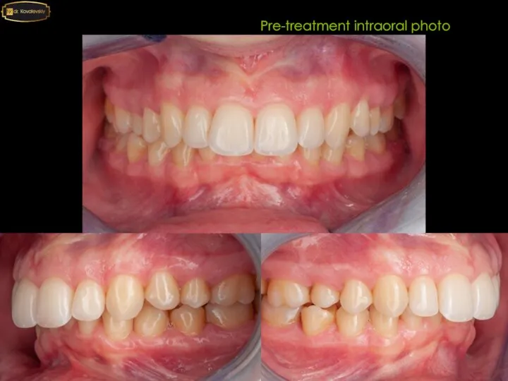 Pre-treatment intraoral photo
