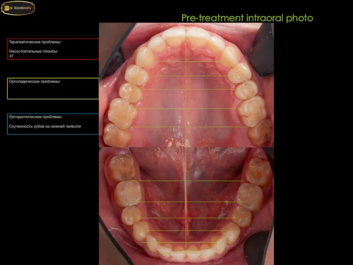 Pre-treatment intraoral photo Терапевтические проблемы: Несостоятельные пломбы: 47 Ортопедические проблемы: Ортодонтические проблемы: