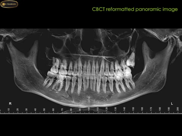 CBCT reformatted panoramic image