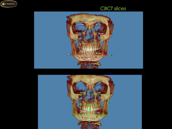 4-4 6-6 CBCT slices