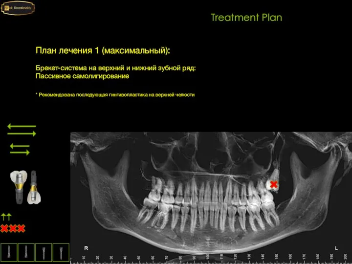 Treatment Plan План лечения 1 (максимальный): Брекет-система на верхний и нижний зубной
