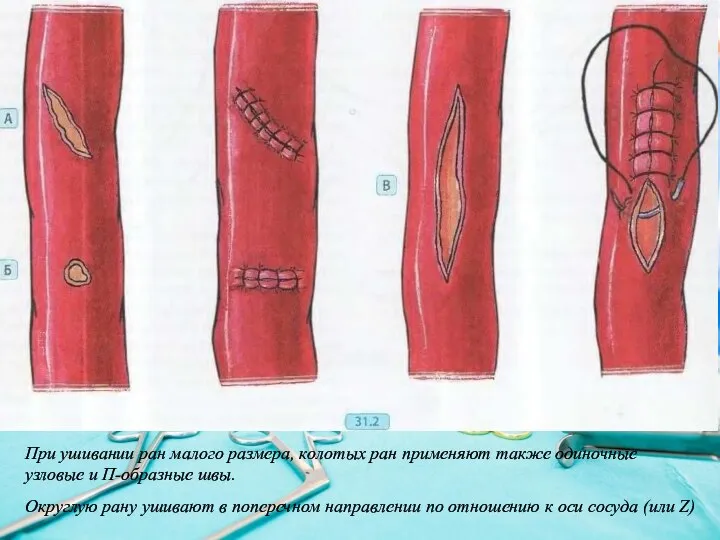 Округлую рану ушивают в поперечном направлении по отношению к оси сосуда (или