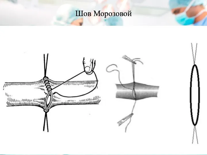 Шов Морозовой