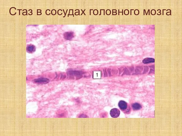 Стаз в сосудах головного мозга