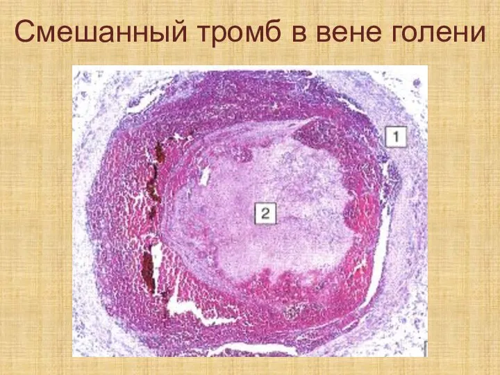 Смешанный тромб в вене голени