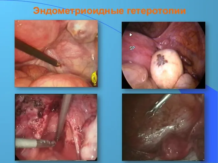 Эндометриоидные гетеротопии