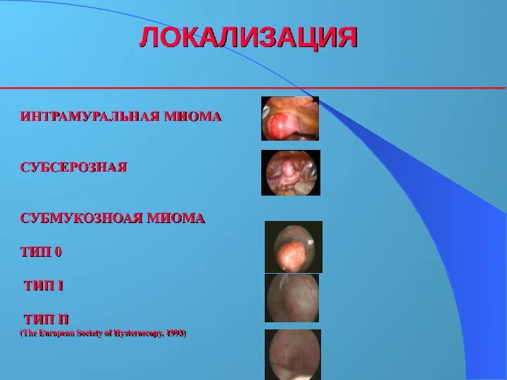 ЛОКАЛИЗАЦИЯ ИНТРАМУРАЛЬНАЯ МИОМА СУБСЕРОЗНАЯ СУБМУКОЗНОАЯ МИОМА ТИП 0 ТИП I ТИП II